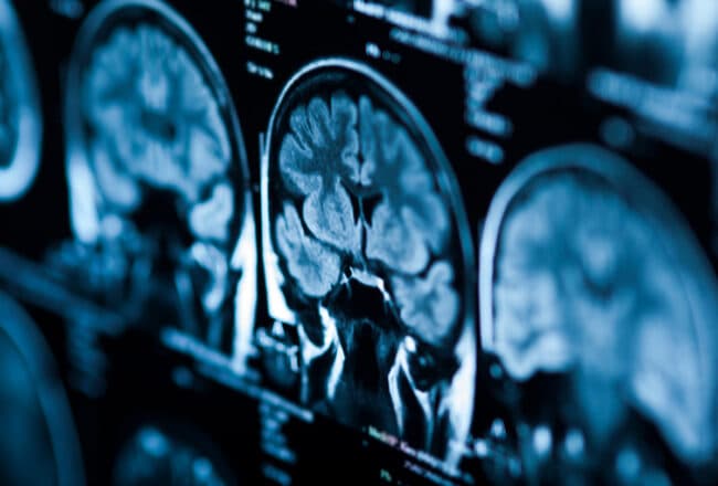 Röntgenaufnahme des menschlichen Gehirns